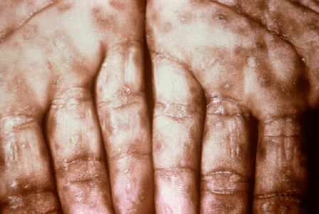 Hình ảnh bệnh giang mai ở bàn tay